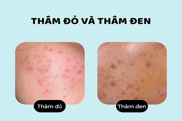 Nguyên nhân bị thâm mụn kem trị mụn thâm trắng da, kem tri mun tham trang da, top 5 kem trị thâm mụn, kem trắng da trị thâm mụn, kem trị mụn thâm trắng da hiệu quả, kem face trị mụn thâm trắng da, kem trị mụn thâm đỏ, sản phẩm trị mụn và thâm, kem dưỡng trắng trị thâm mụn
