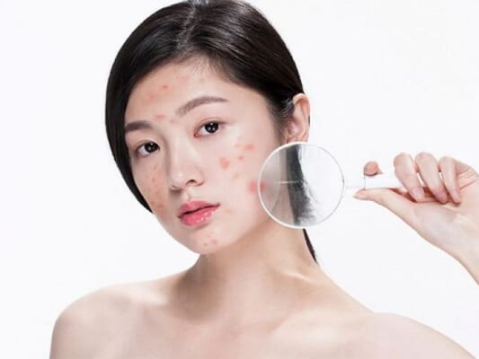 Điều trị mụn
